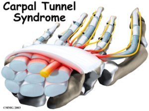 Come curare tunnel carpale senza operazione