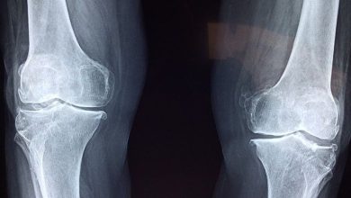 Come sbloccare il ginocchio dopo intervento
