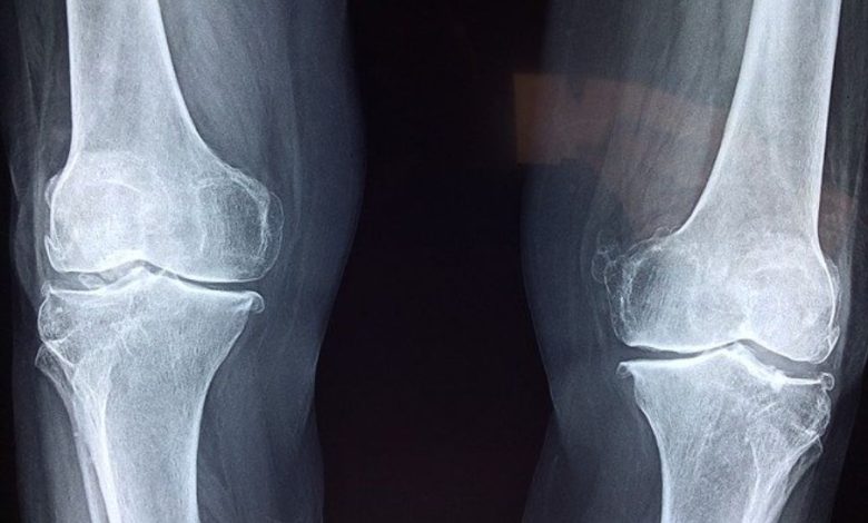 Come sbloccare il ginocchio dopo intervento
