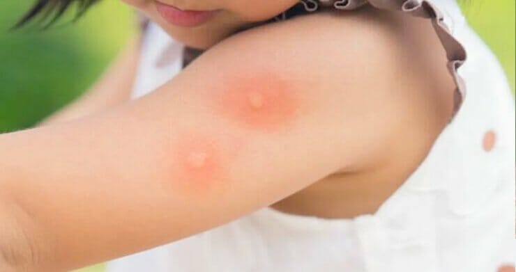 Punture di zanzare come farle sgonfiare